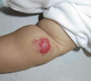 Hemangioma infantil mixto