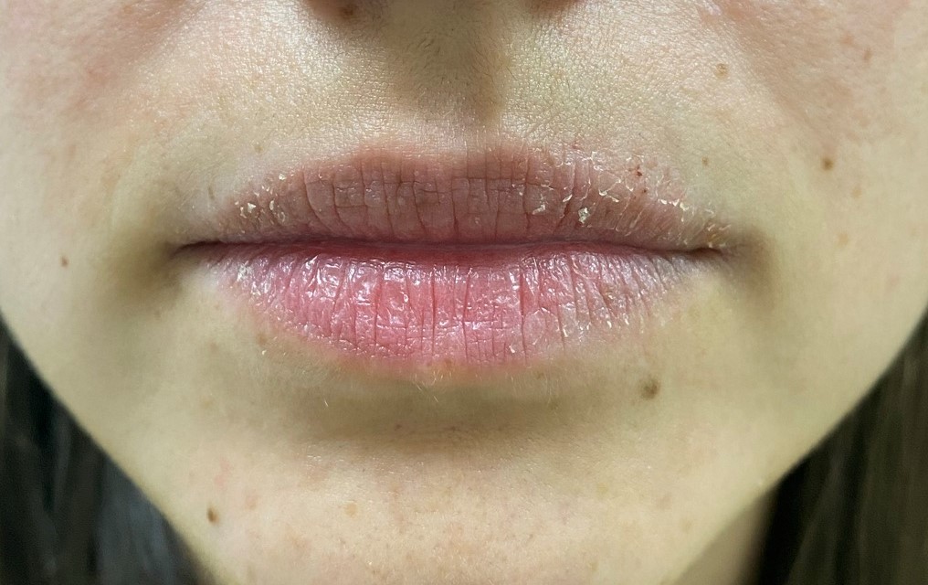 labios secos y agrietados