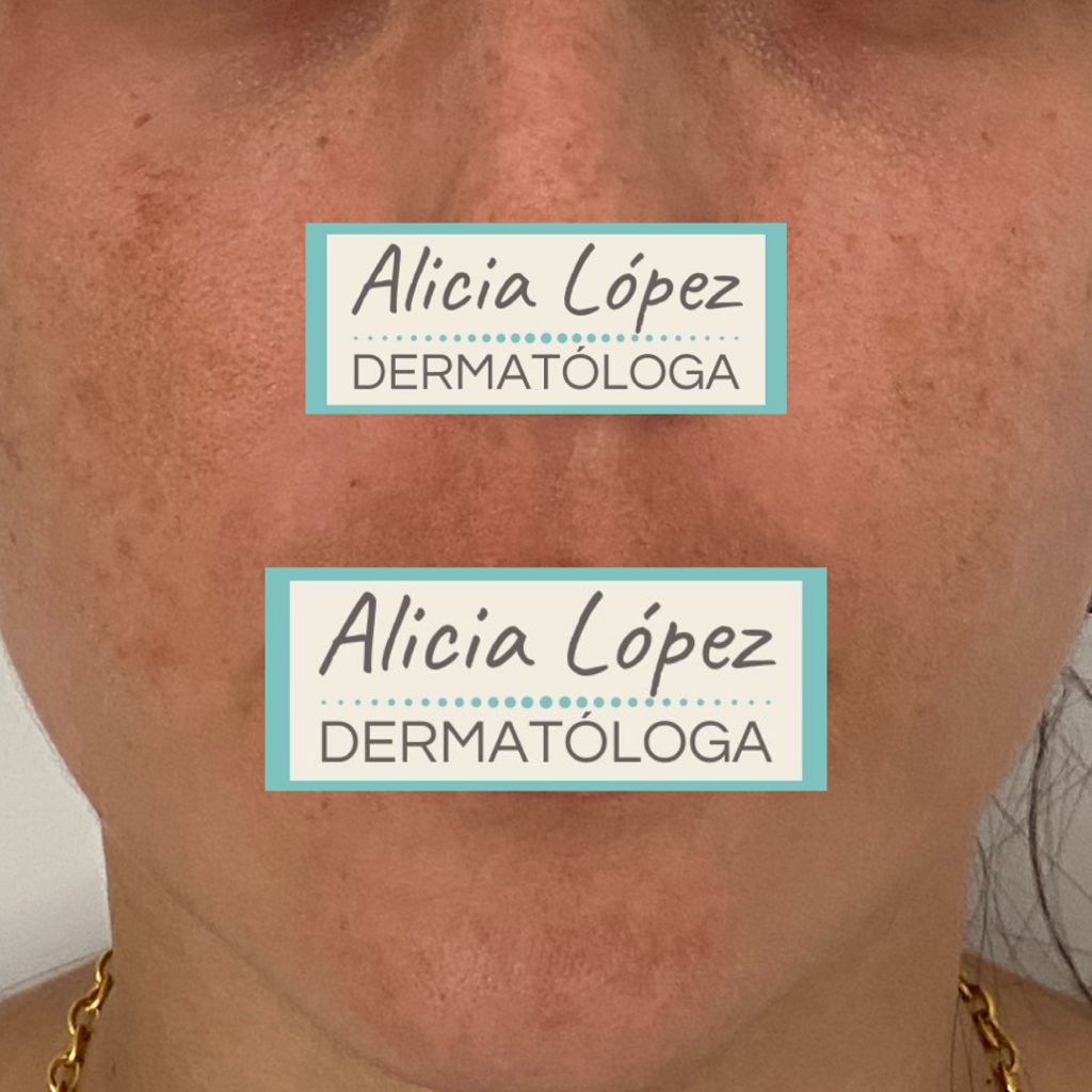 melasma facial