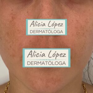 Melasma centrofacial