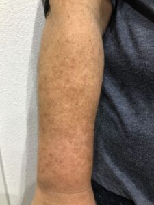 Melasma en dorso de antebrazos