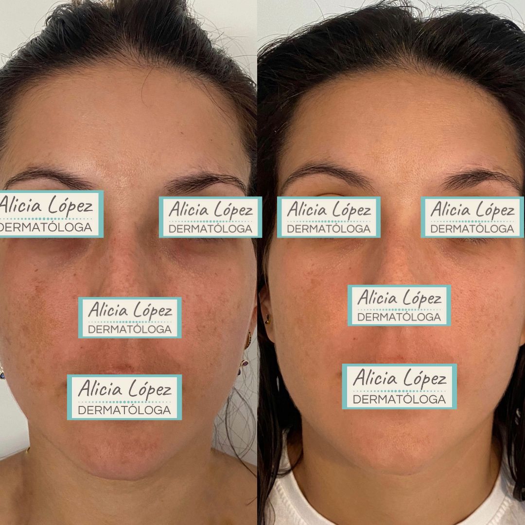 Melasma facial: antes y un mes después de tratamiento tópico combinado únicamente