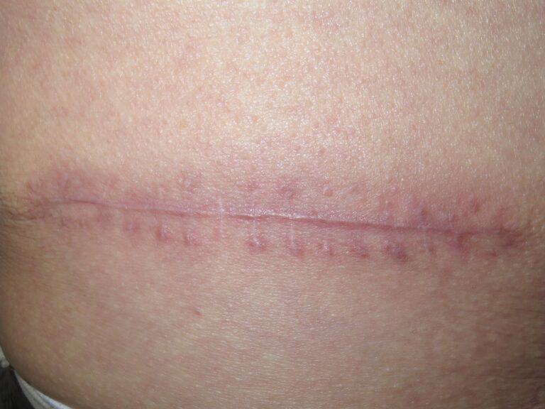 Cicatriz sutura