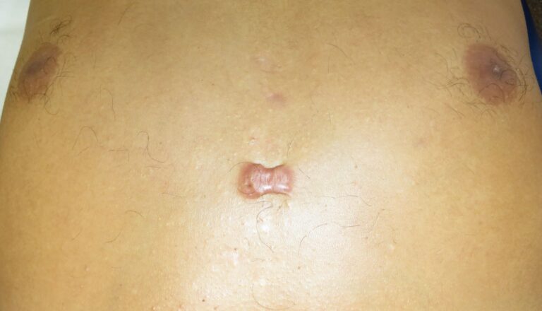 Queloide