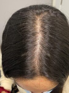 Esta paciente acudía a consulta por ensanchamiento de la raya del pelo y presentaba una alopecia androgénica incipiente