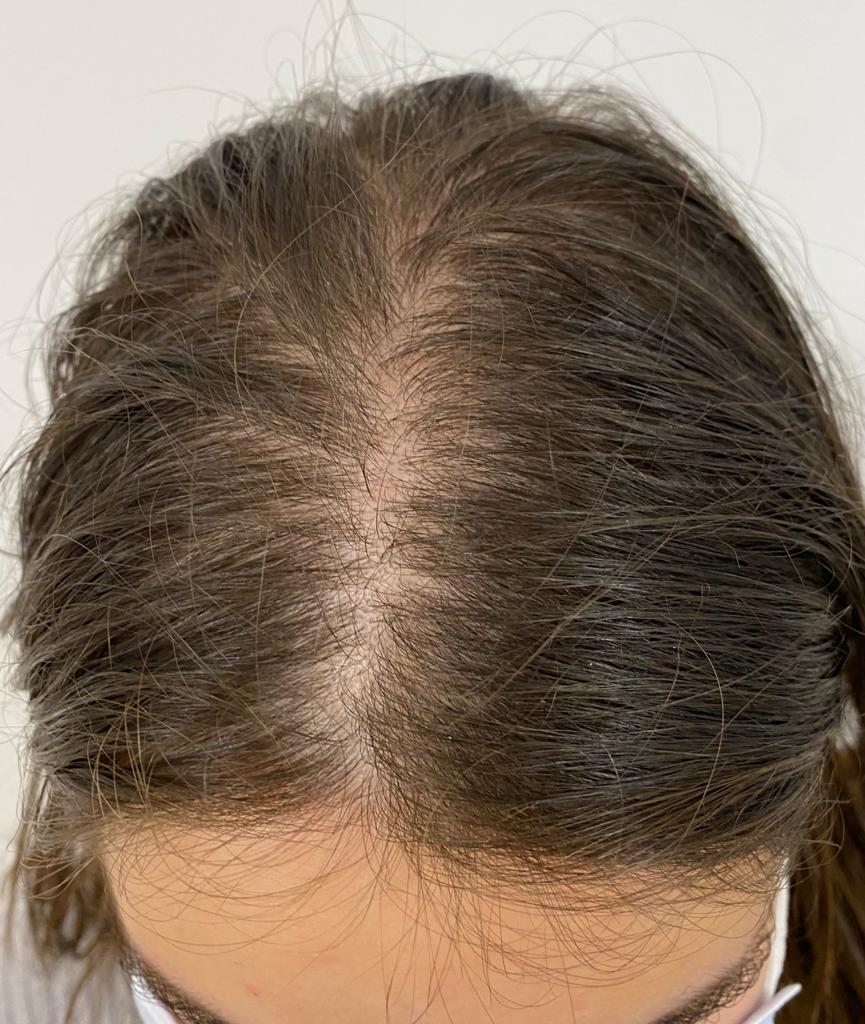 Alopecia androgénica femenina