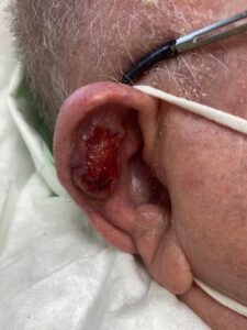 Carcinoma espinocelular en pabellón auricular