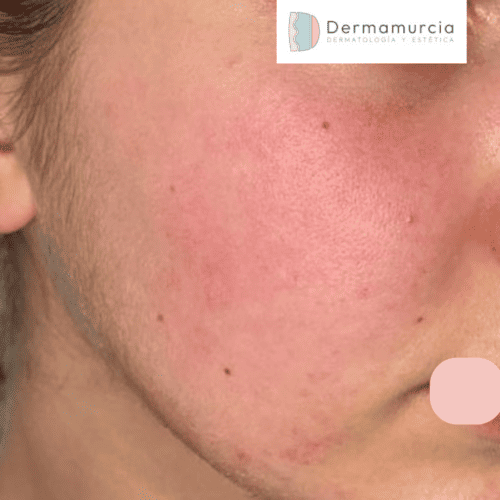Rubor facial transitorio benigno