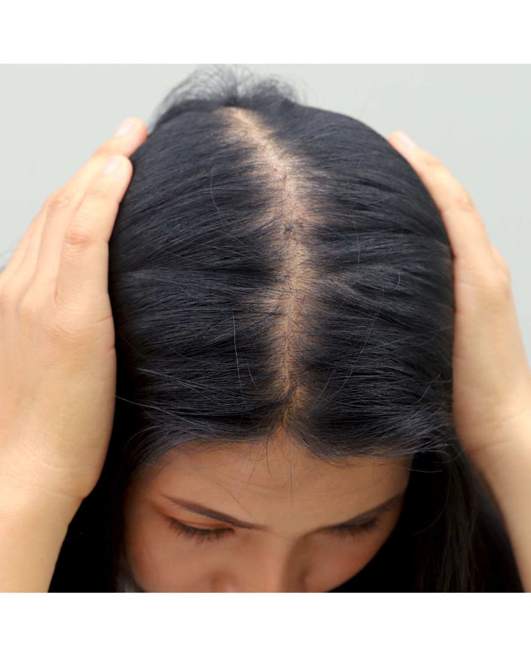 Alopecia androgenica femenina