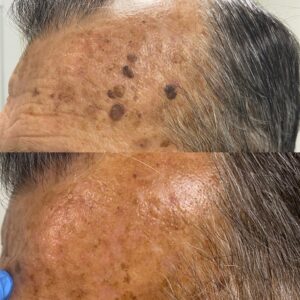 Queratosis seborreicas tratadas con láser de CO2