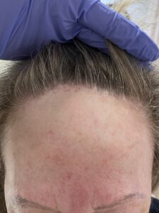 Alopecia frontal fibrosante