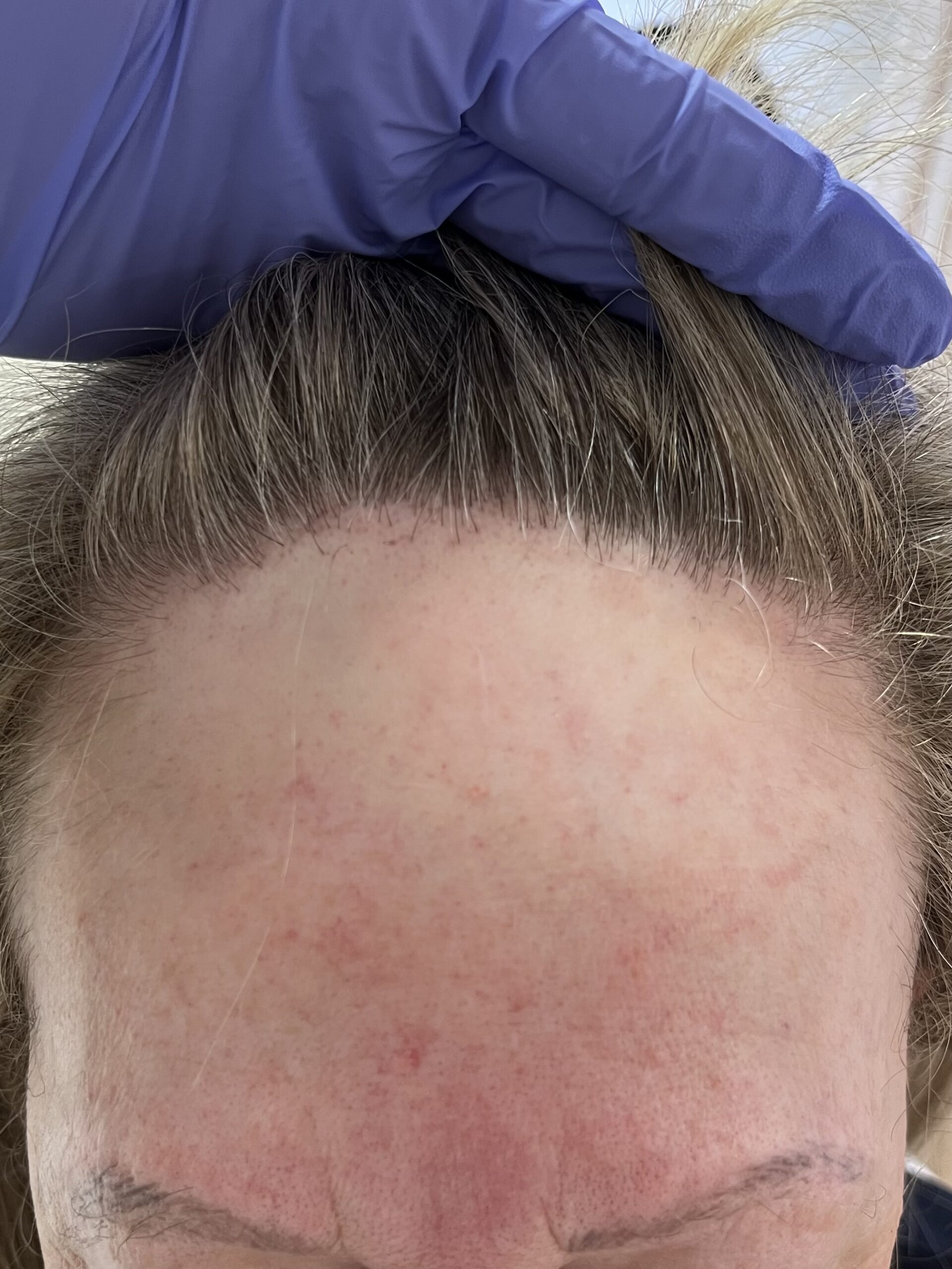 Alopecia frontal fibrosante