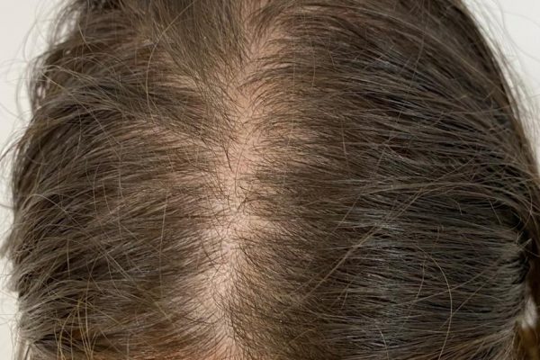 Alopecia androgénica femenina