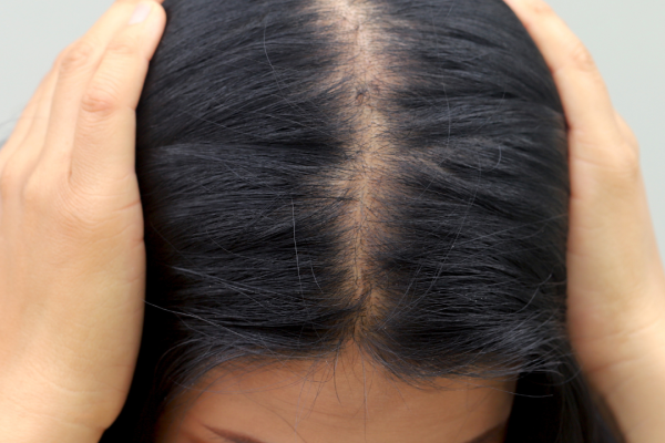 alopecia androgénica femenina Alopecia androgenica femenina