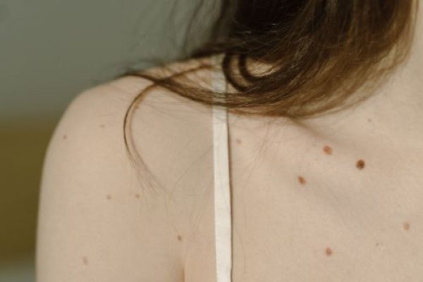 dermatologia murcia